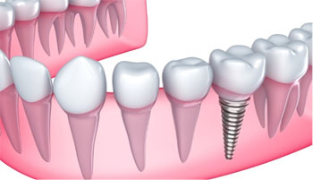 dental implants