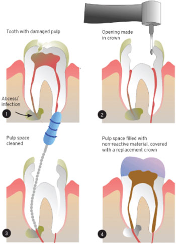 root canal treatment