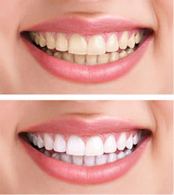 teeth whitening