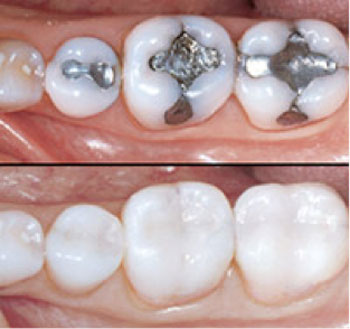 white composite fillings